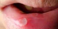 6 Penyebab Mulut Sariawan Yang Sering Terjadi