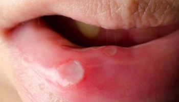 6 Penyebab Mulut Sariawan Yang Sering Terjadi